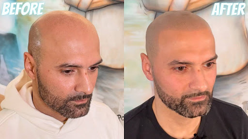 Scalp Micropigmentation Manchester